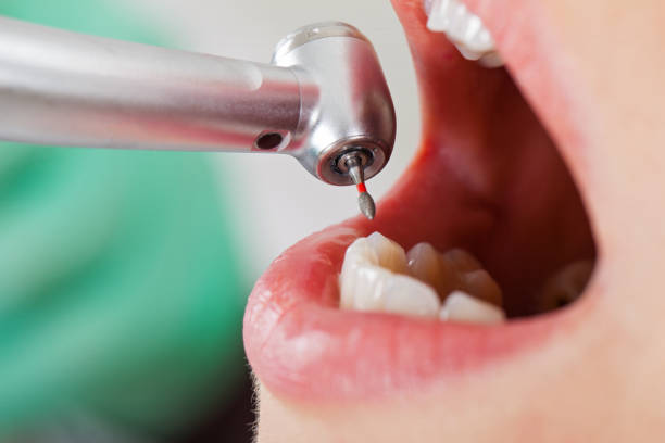 Best Dental Abscess Treatment in Armona, CA